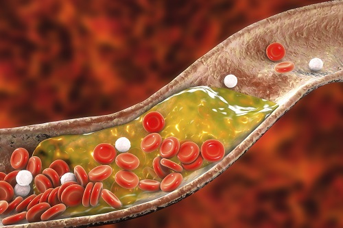 New Nanoparticle Drug Combination For Atherosclerosis 이미지