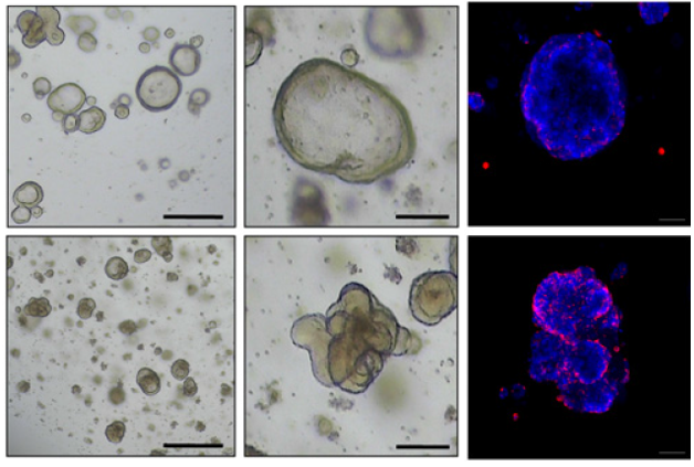 Expression of SETDB1 in colorectal cancer tissues and cellular differentiation of patient-derived colon cancer organoids upon SETDB1 depletion