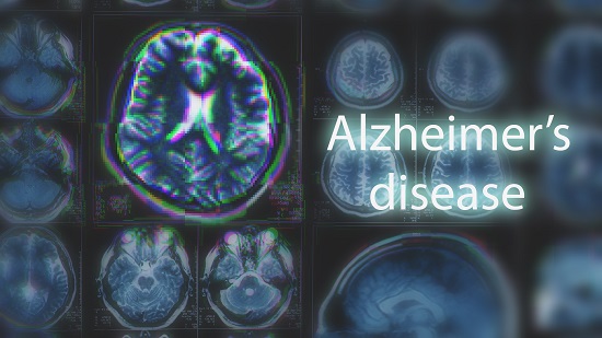 Blood-Based Multiplexed Diagnostic Sensor Helps to Accurately Detect Alzheimer's Disease 이미지1