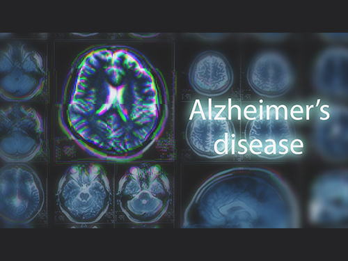 Blood-Based Multiplexed Diagnostic Sensor Helps to Accurately Detect Alzheimer’s Disease 이미지