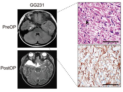 Understanding Epilepsy in Pediatric Tumors; New Therapeutic Target of Intractable Epilepsy Identified 이미지