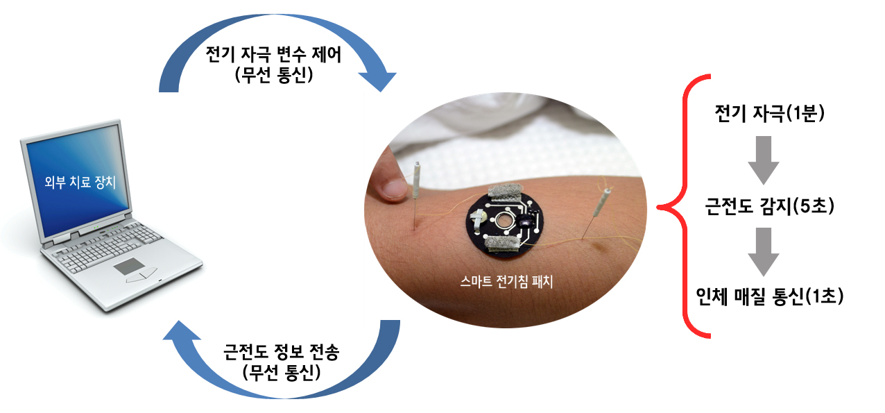 초소형 스마트 침 시스템 개발 이미지