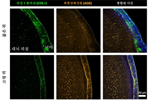 노화된 뇌막 속 쌓인 당이 장애 유발 최초 규명 이미지