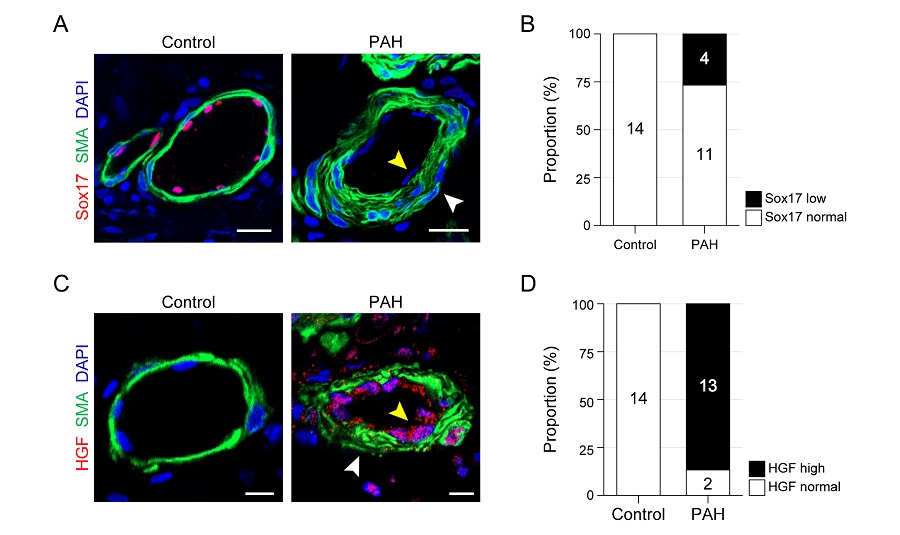그림 2. 폐동맥 고혈압 환자에서의 폐동맥 Sox17 발현 감소(노란 화살표) 및 혈관평활근 비대(흰 화살표)